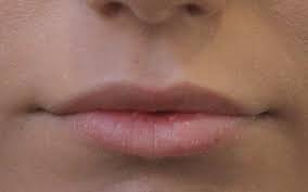 0.5ml hyaluron acid pen ampullen nadeln lippen falten + ampullenkpf umrüstkopf. Filler Vorher Nachher Bilder Lippen Vorher Nachher