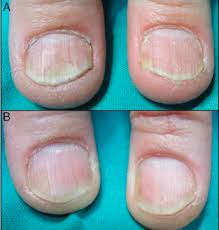 nail psoriasis with pulse dye laser