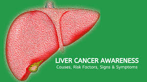 It may spread to other tissues in the body through the blood or through lymph nodes. Liver Cancer Causes Symptoms Diagnosis Treatment Jmexclusives