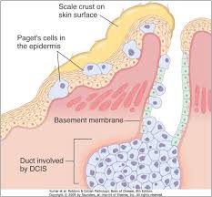 Paget's disease of the breast was described by sir james paget in 1874. Paget Disease Of Breast Histology Atopic Dermatitis Symptoms