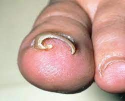 an ingrown toenail
