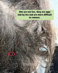 remove nits from hair without a comb