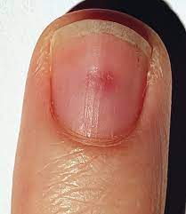 mri of glomus tumors of the fingertips