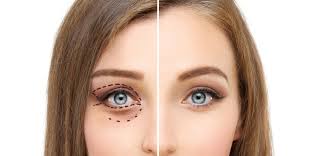 eyes to the benefits of eyelid surgery