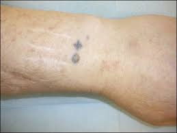 Paramedical tattooing, also known as medical tattooing, and medical micropigmentation can be applied in many ways. A New Purpose For Tattoos Medical Alert Tattoos Sciencedirect