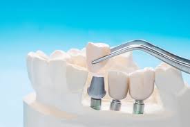 The coverage for a crown is usually 50% of the cost of the procedure, with the patient liable for the rest. Will My Dental Insurance Cover Dental Implants Cosa