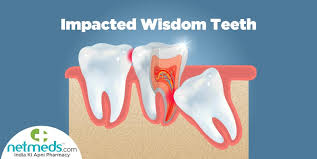 impacted wisdom teeth causes symptoms