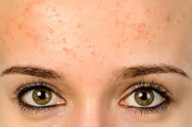 fungal acne how to know if you have it