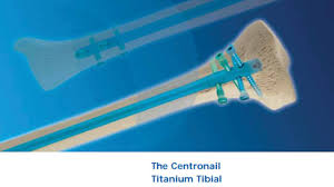 centronail anium tibial nail orthofix