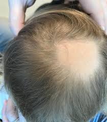a toddler presents with patchy hair