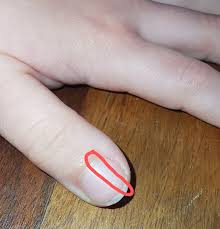 finger nail melanoma skin cancer