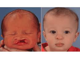 what is cleft lip palate surgery is