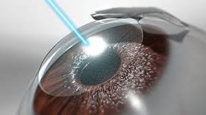 However, while lasik permanently corrects the vision problem you come into surgery with, it doesn't. Lasik Uci Health Orange County Ca