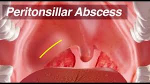 peritonsillar abscess identification