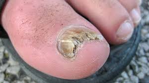 nail psoriasis vs fungus learn the signs