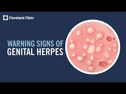 5 warning signs of herpes you