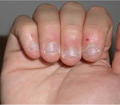 nail diseases and disorders flashcards