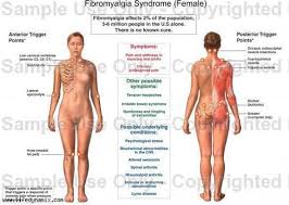 Trigger Points Chart Females Fibromyalgia Fibromyalgia