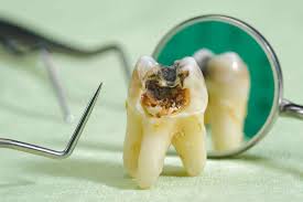 rotten teeth causes symptoms and