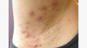 hidradenitis suppurativa in armpits