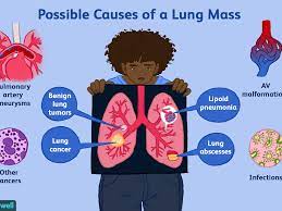 Some very noticeable symptoms of lung cancer, such as persistent cough, are directly associated with pulmonary (lung) function and are reasonably well • cushing's syndrome, an overproduction of adrenal hormones by cancerous tissue. Possible Causes Of A Lung Mass