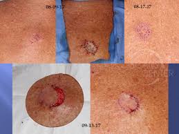Find facts and statistics for reporting about skin cancer. Additional Margin Excision After Skin Grafting Skin Cancer And Reconstructive Surgery Center