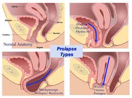 prolapse help unity studios