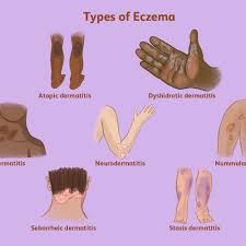 best ayurvedic treatments for eczema in