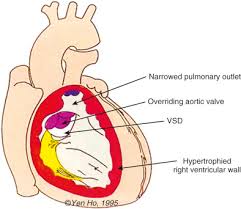 Atrial septal defect asd medlineplus medical encyclopedia. Simplified Guide To Understanding The Anatomy Of Congenital Heart Disease Sciencedirect
