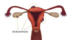 We did not find results for: Endometriosis Symptoms Causes Stages Treatment In Mumbai