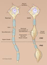 giant axonal neuropathy medlineplus