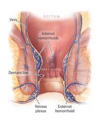 This is called a thrombosed hemorrhoid. Hemorrhoid Treatment Specialist Nyc New York City Hemorrhoid Doctor