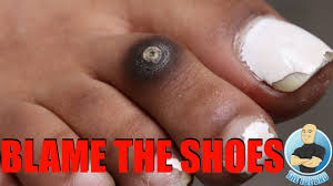 uh oh my toe is turning black