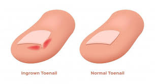 the dangers of ingrown toenails