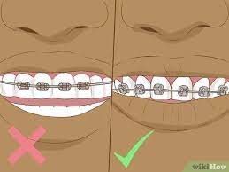 No, you cannot make fake braces at home. 3 Ways To Make Fake Braces Or A Fake Retainer Wikihow