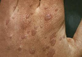 warts why they appear on the skin