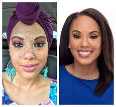 abc 13 anchor frees her freckles to