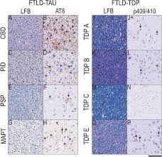 Hopefully this guide will help you get just a little bit better. Frontotemporal Lobar Degeneration Proteinopathies Have Disparate Microscopic Patterns Of White And Grey Matter Pathology Acta Neuropathologica Communications Full Text