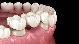 gum pain around the dental bridge