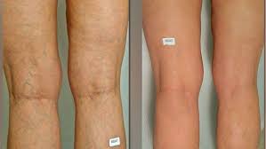 spider veins texila connect