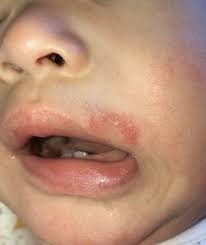 rash above lip pic babycenter