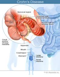 Crohns Disease Anatomy And Physiology Causes Symptoms