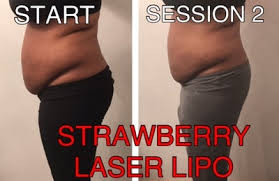 strawberry laser lipo review realself