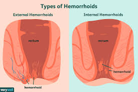 coping with hemorrhoids how to sit and