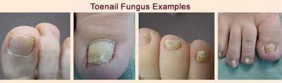 nail fungus indy podiatry michael j