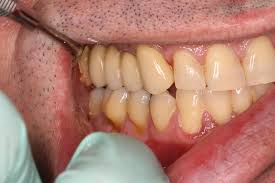 Rabe se ako se tlo dobre nosivosti nalazi na dubini do oko 5 ÷ 7 m. Zubni Implantati I Ugradnja Zubnih Implantata Dentalni Centar Dvojkovic
