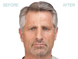 Maybe you would like to learn more about one of these? Botox Dysport Xeomin Jeuveau Dermatology Specialists Of Naples Naples Fl Botox
