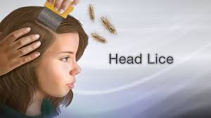 head lice information mount sinai
