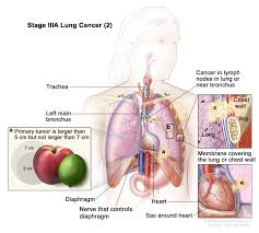 Non Small Cell Lung Cancer Treatment Pdq Health