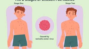 Image result for chicken pox